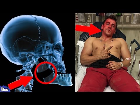 10 YouTuber Injuries Caught on Camera (TGFbro, NigaHiga, W2S, Vitalyzd TV, Joe Weller etc)