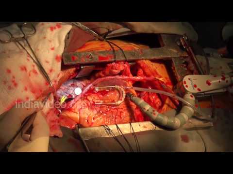 Live Open Heart Surgery in Hospital - Heart Operation Videos