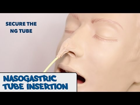 Nasogastric (NG) Tube Insertion - OSCE Guide