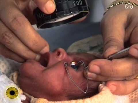 ROP , Retinopathy of prematurity