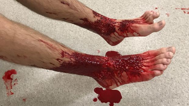 Teenager Sam Kanizay's bloody legs after possibly being bitten by something while bathing at Brighton.