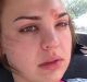 Katie Wright, a 21-year-old from Austin, Texas recently shared that she tried picking at a blemish near her eyebrow