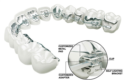 Lingual Braces