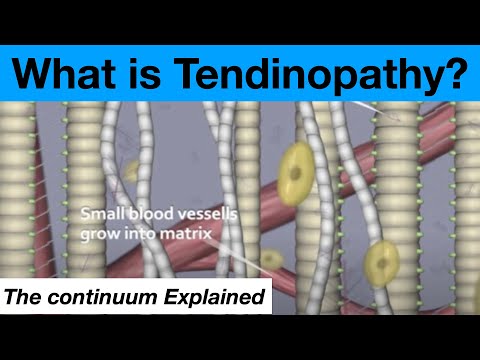 Tendinopathy Continuum Explained