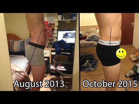 How to Fix APT (Anterior Pelvic Tilt) - EatLiftGain