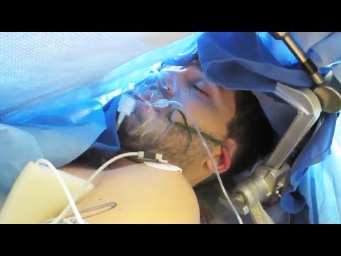 AWAKE BRAIN SURGERY (Uncensored) - Resection of Oligodendroglioma, Right Frontal Lobe