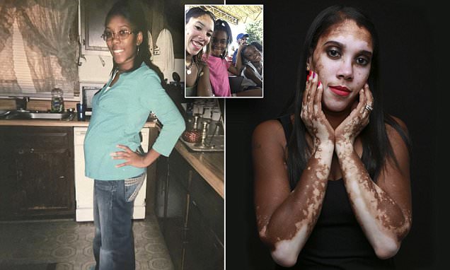 Virginia woman with vitiligo now makes light of condition