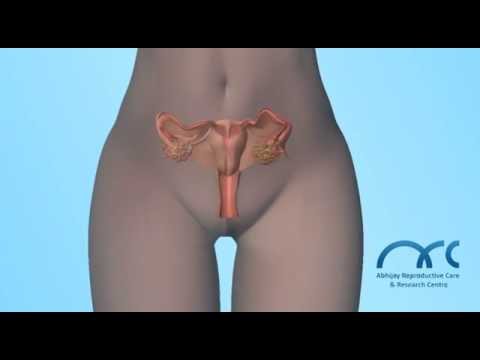 Hysterosalpingogram Procedure | Hysterosalpingogram Video - ARC Chennai