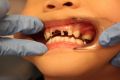 More than one-third of NSW children aged five to 10 have decay in their baby teeth.