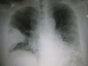 Pneumonia of Right Lung Middle Lobe