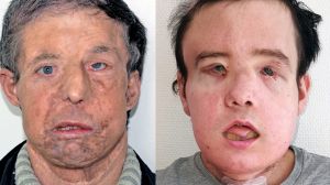 Jerome Hamon before and after two face transplants.