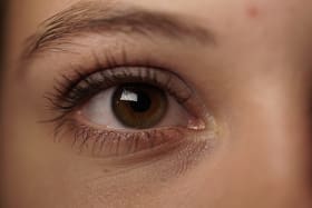 Why do we get dark circles under our eyes?