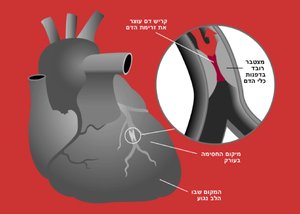 Heart attack diagram he