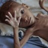 More than 85,000 Yemeni children may have died from hunger, aid group says