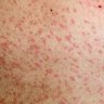 Latest measles case in NSW prompts warning from NSW Health