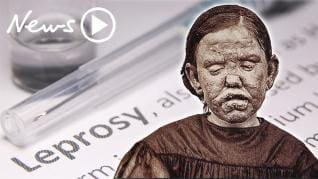 The shocking effects of leprosy