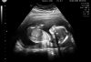 Ultrasound of Emma - 20 weeks old. Credit: Michael Fürstenberg/Flickr