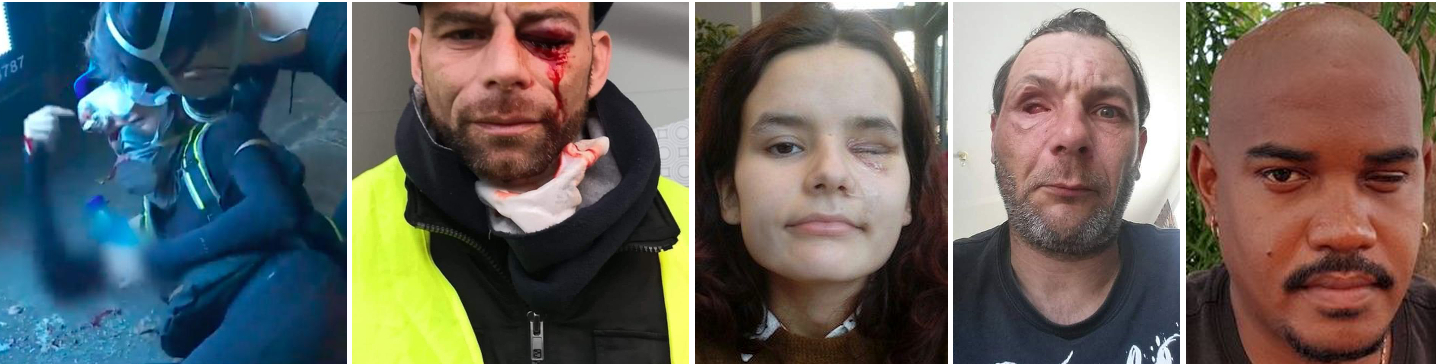 Eye injuries sustained by Hong Kong protester and 4 of the 24 Gilets Jaunes who have lost an eye since November 2018