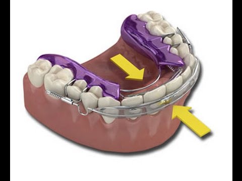 What is an Inman Aligner?