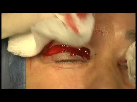 Skin only upper blepharoplasty