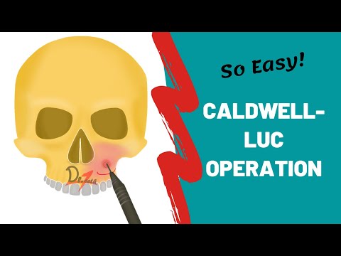 Caldwell-Luc Operation | ORAL SURGERY