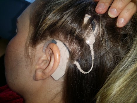 Cochlear implant