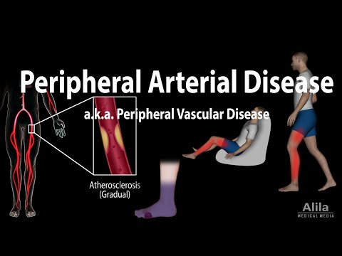 Peripheral artery disease: Pathophysiology, Causes, Symptoms,  Diagnosis and Treatments, Animation