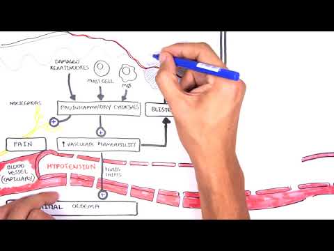 Burns (DETAILED) Overview - Types, Pathophysiology, TBSA