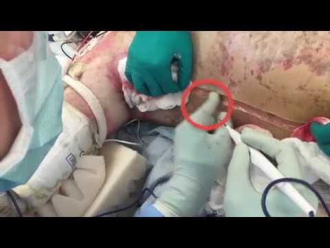 Burns 102: Escharotomy for 3rd Degree (Full-Thickness) Burns