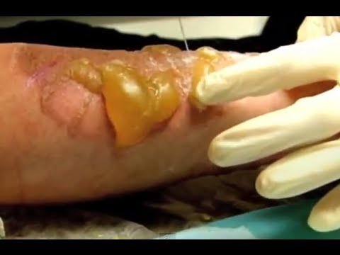 Hot Fat Burns - Bizarre ER