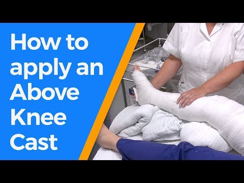 How to apply an Above Knee Cast