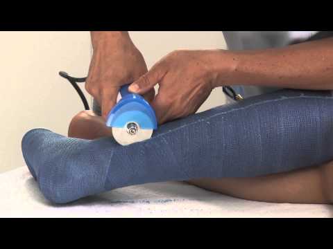 Synthetic Lower Leg Cast Removal