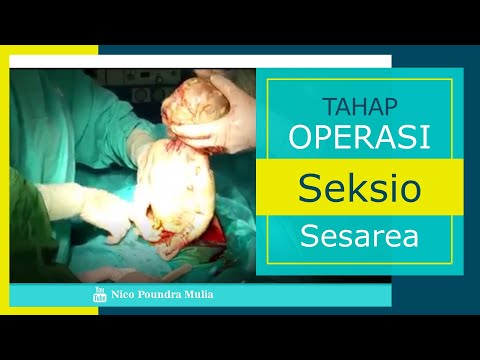 Step by step operasi seksio sesarea (Sectio Caesarea)