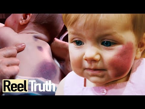 The Baby Who Bruised Easily - Glanzmann's Thrombosthenia | Medical Documentary | Reel Truth