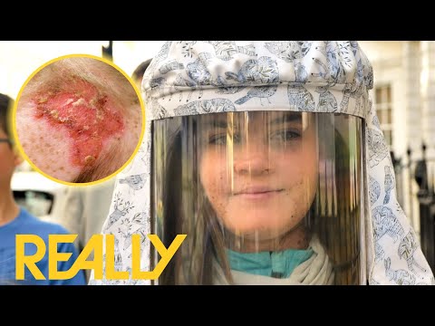 11-Year-Old Has Rare Condition That Makes Her Develop Multiple Skin Cancers | The Bad Skin Clinic