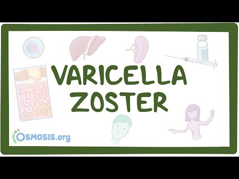 Varicella zoster virus - causes, symptoms, diagnosis, treatment, pathology