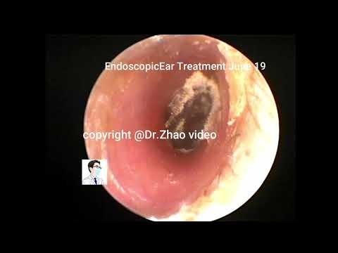 Ear wax removal, Dry pieces wax removal,Cerumen Cleanning,Soften the blockage and clean up