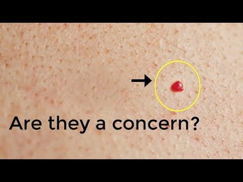 Do You Have These Red Spots On Various Parts of Your Body Should You Worry? | Very Important To know