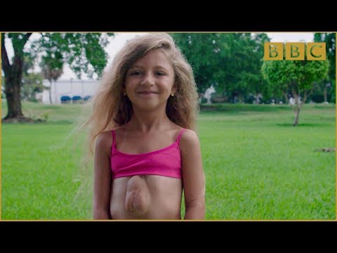 The girl born with heart outside her chest - Incredible Medicine: Dr Weston's Casebook Preview - BBC