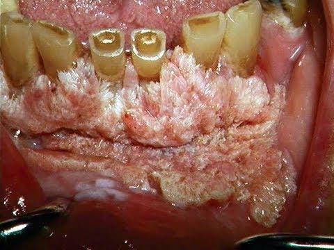 What Snus Can Do To Your Gums | Dipping & Oral Cancer