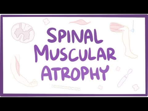 Spinal muscular atrophy - causes, symptoms, diagnosis, treatment, pathology