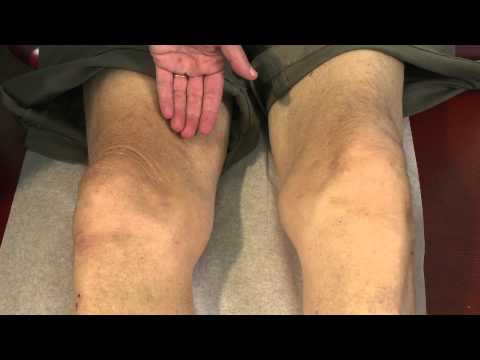 Quadriceps Atrophy