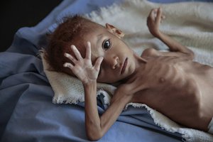 FILE - In this Oct. 1, 2018, file, photo, a severely malnourished boy rests on a hospital bed at the Aslam Health Center, Hajjah, Yemen.