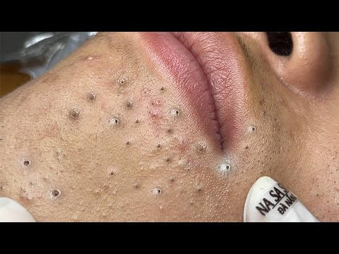 Blackheads And Large Hidden Acne On The Chin