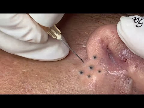 Blackheads And Large Hidden Pimples On Earlobes