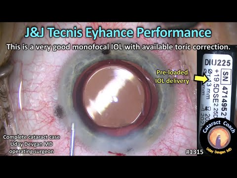 CataractCoach 1315: J&J Tecnis Eyhance monofocal IOL performance