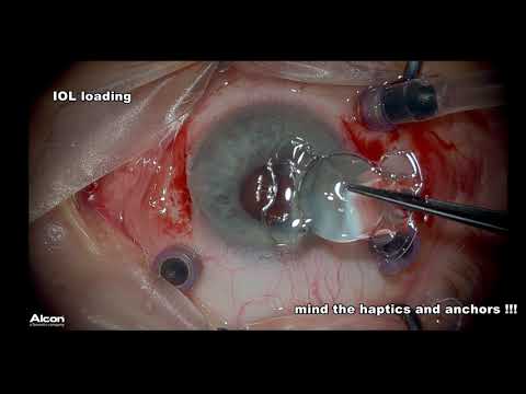 Carlevale IOL implantation , with scleral pockets