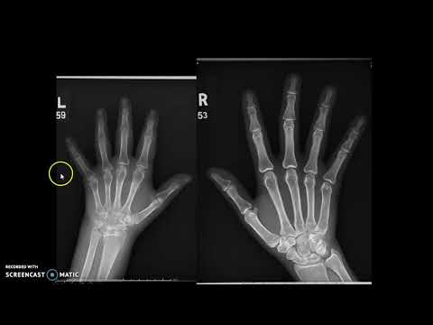 Hand, Finger & Thumb x-ray protocol