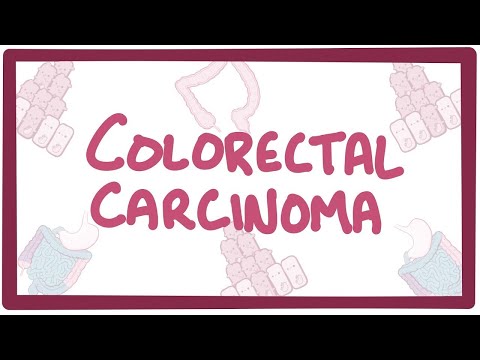 Colorectal carcinoma - causes, symptoms, diagnosis, treatment, pathology