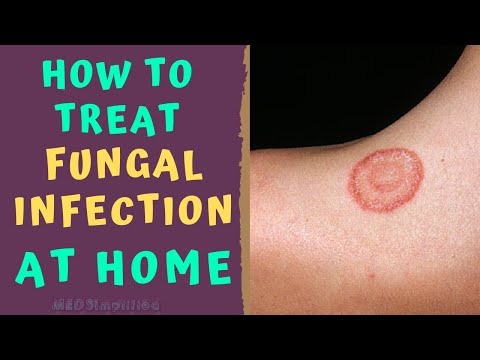 HOW TO TREAT SKIN FUNGAL INFECTION INFECTION AT HOME   TINEA RINGWORM REMEDIES HOW TO CURE